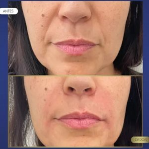 Harmonização Facial