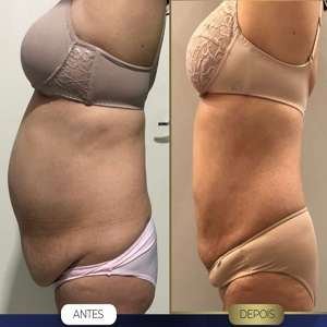 Hidrolipo