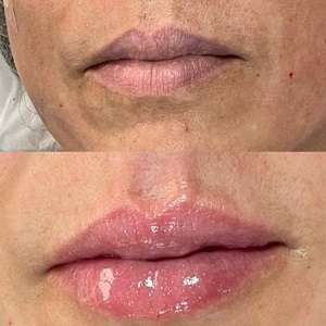 Preenchimento Labial