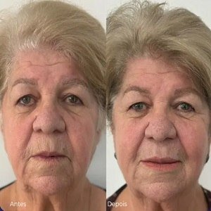 Rejuvenescimento Facial